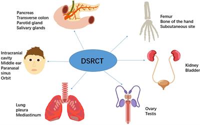 Intra-Abdominal Desmoplastic Small Round Cell Tumor: Current Treatment Options and Perspectives